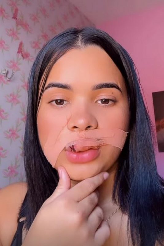 A jovem compartilhou nesta quinta-feira (21) como anda a recupera&ccedil;&atilde;o – Foto: Redes Sociais/Reprodu&ccedil;&atilde;o/ND