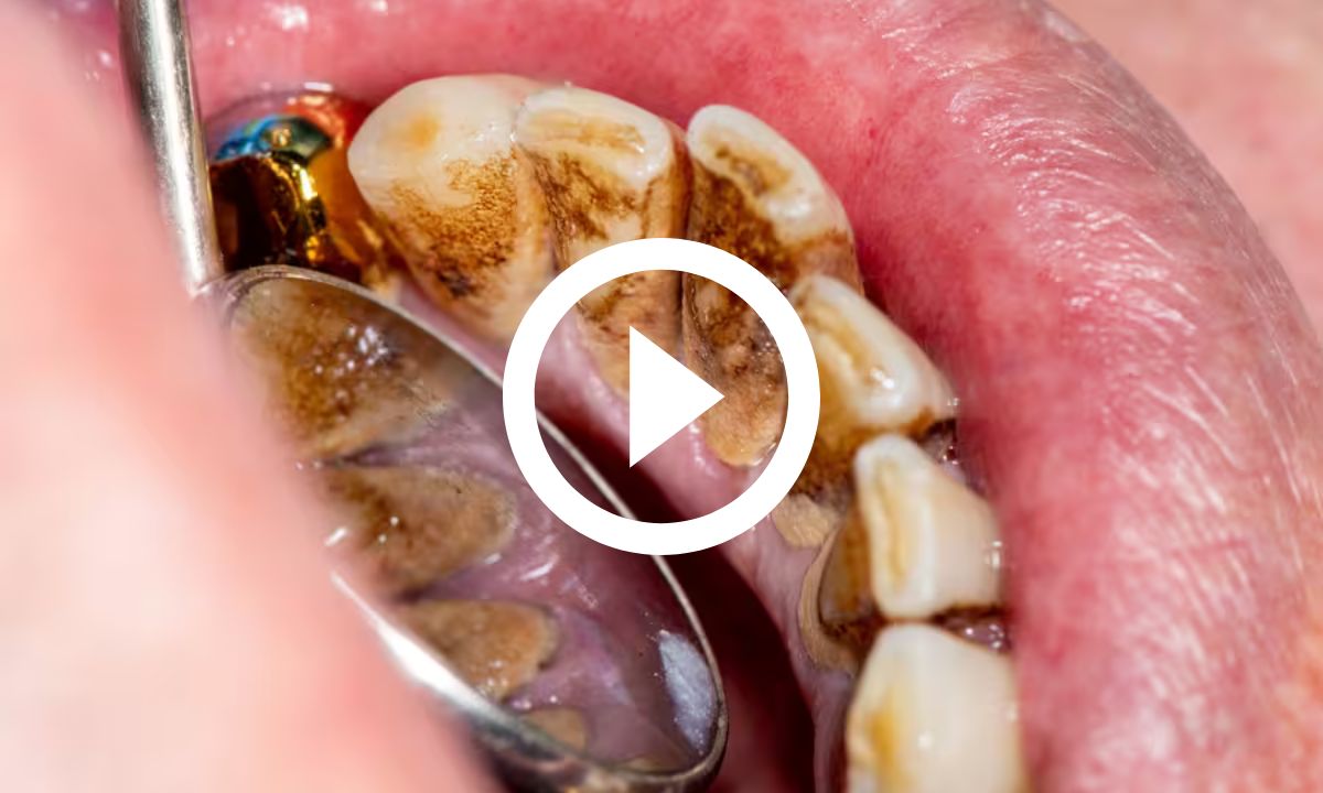 Mau hálito: 3 dicas caseiras para tirar tártaro e o bafinho