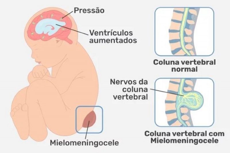 mielomeningocele é uma condição congênita 