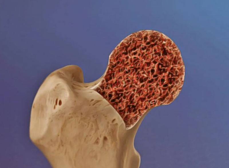 Ossos quebradiços, dor nas costas e formigamento são sintomas de osteoporose