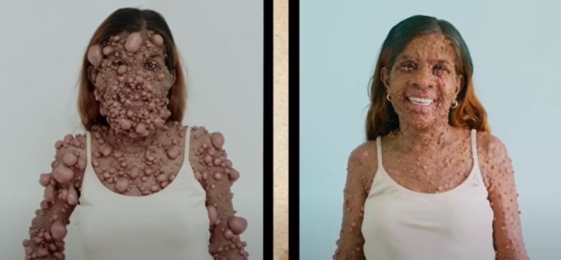 O antes e depois de Charmaine, após a cirurgia de retirada dos tumores &#8211; Foto: Reprodução/YouTube