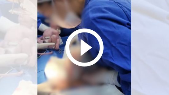 VÍDEO: Mãe grávida de gêmeos tem parto raro em Joinville e bebê nasce empelicado