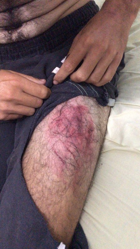 Foto de lesões causadas por tortura em Balneário Camboriú