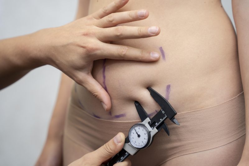 Paciente tirando medidas antes do procedimento de lipo sem corte