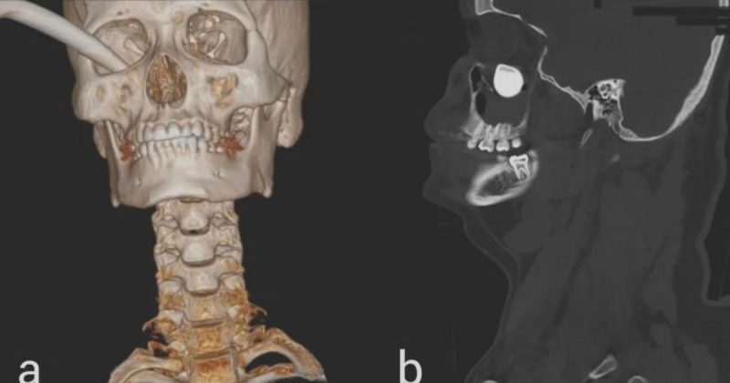 Descoberta bizarra feita em um homem da Malásia