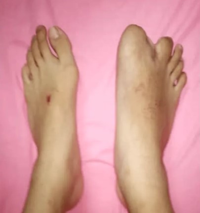 Antes e Depois: menina recupera mobilidade após anomalia rara nos pés