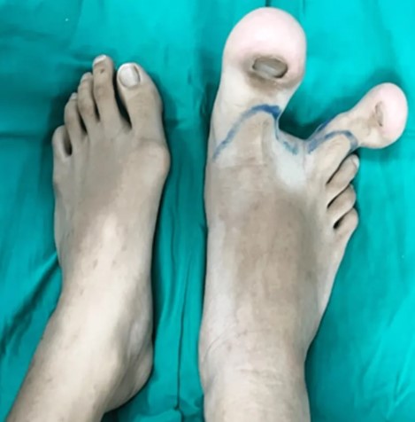 Antes e Depois: menina recupera mobilidade após anomalia rara nos pés