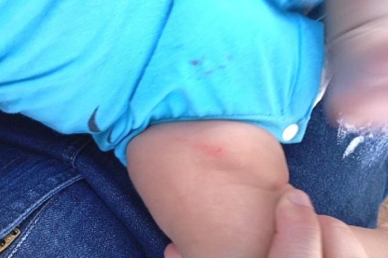 bebê com lesões nas pernas