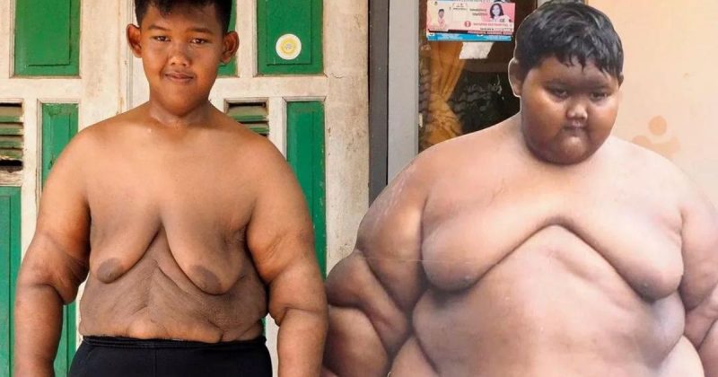 Antes e depois do menino mais gordo do mundo