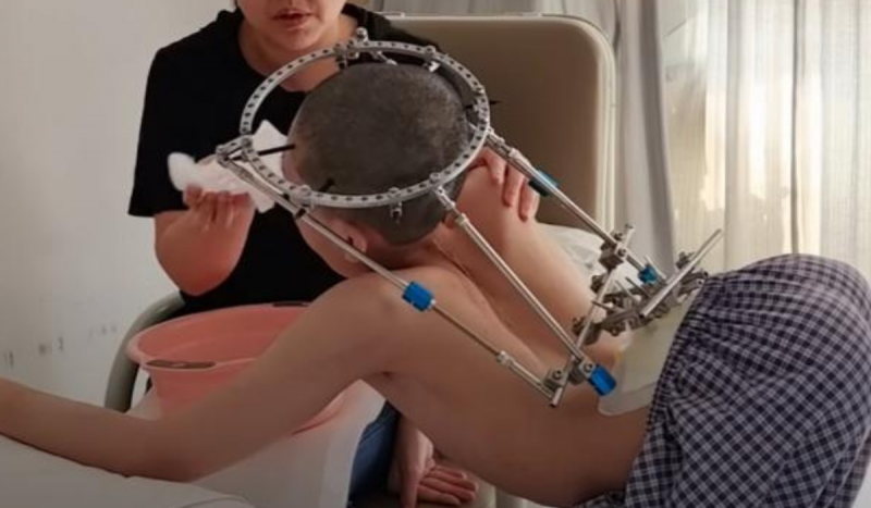 Menino de costas com ferros e suportes fixos na cabeça e na coluna