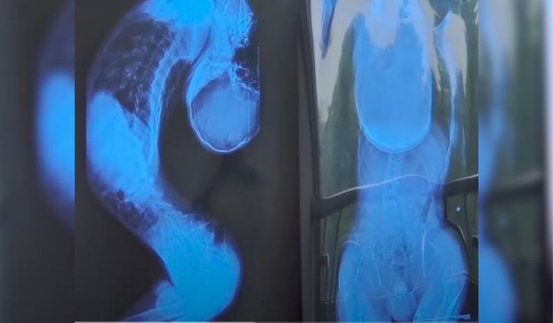 Raio-x azul mostra coluna dobrada