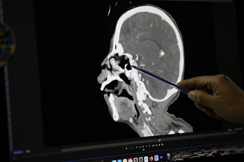 Exame mostrou que larvas estavam presentes no céu da boca da paciente