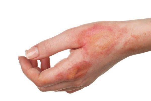 Exemplo de queimadura química