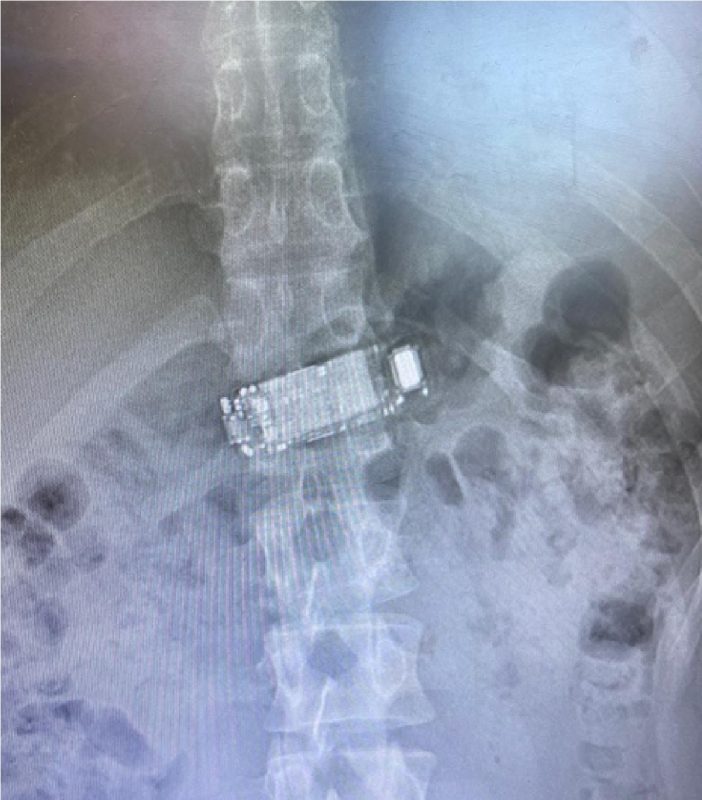 Raio-X mostra celular dentro do corpo do detento de Presídio Regional 