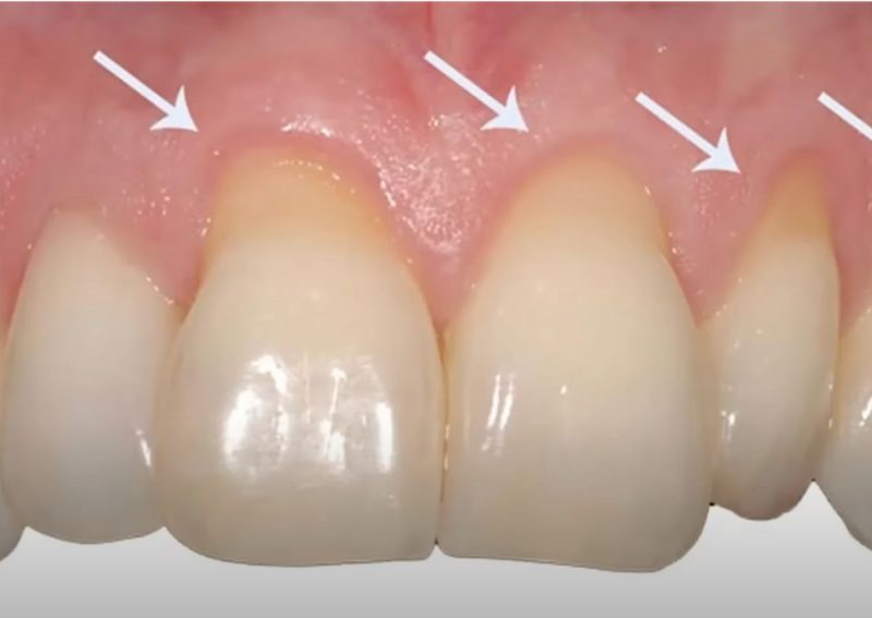 Tártaro é apenas um dos males da ação de bactérias na boca