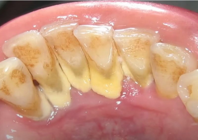 Placas se formam na base dos dentes em a&ccedil;&atilde;o que protege bact&eacute;rias das defesas do organismo – Foto: Reprodu&ccedil;&atilde;o