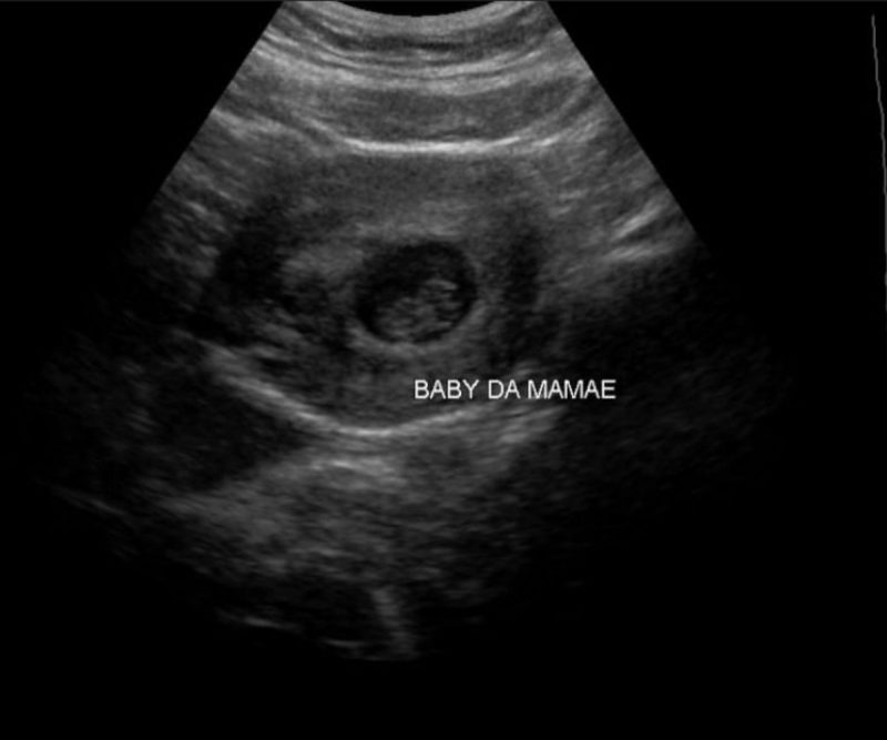 No Dia das Mães, Lumena publicou fotos de ultrassom antes de sofrer aborto