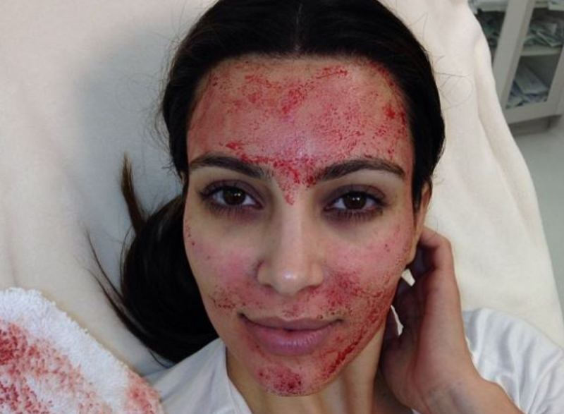 Famosas, como Kim Kardashian, já aderiram ao Vampire Facial