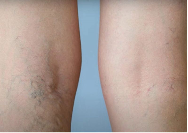 Chá ajuda a combater as varizes