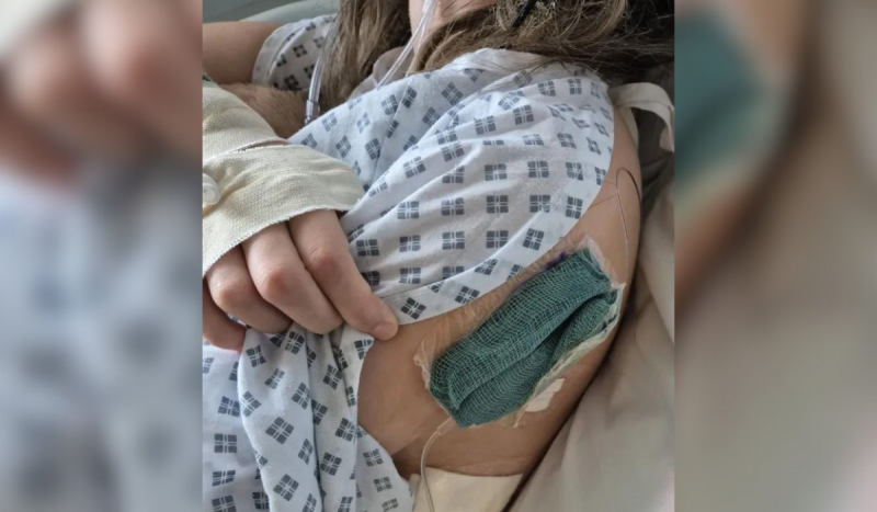 Foto mostra paciente segurando roupa hospitalar e mostrando curativo na região da costela. Imagem é usada para ilustrar matéria sobre adolescente que usava vape e quase morreu