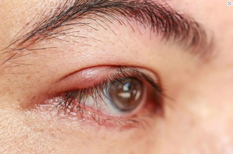 A blefarite &eacute; uma inflama&ccedil;&atilde;o das bordas das p&aacute;lpebras, possivelmente com escamas espessas, crostas, &uacute;lceras superficiais, ou vermelhid&atilde;o e incha&ccedil;o das bordas das p&aacute;lpebras. – Foto: Reprodu&ccedil;&atilde;o/ND