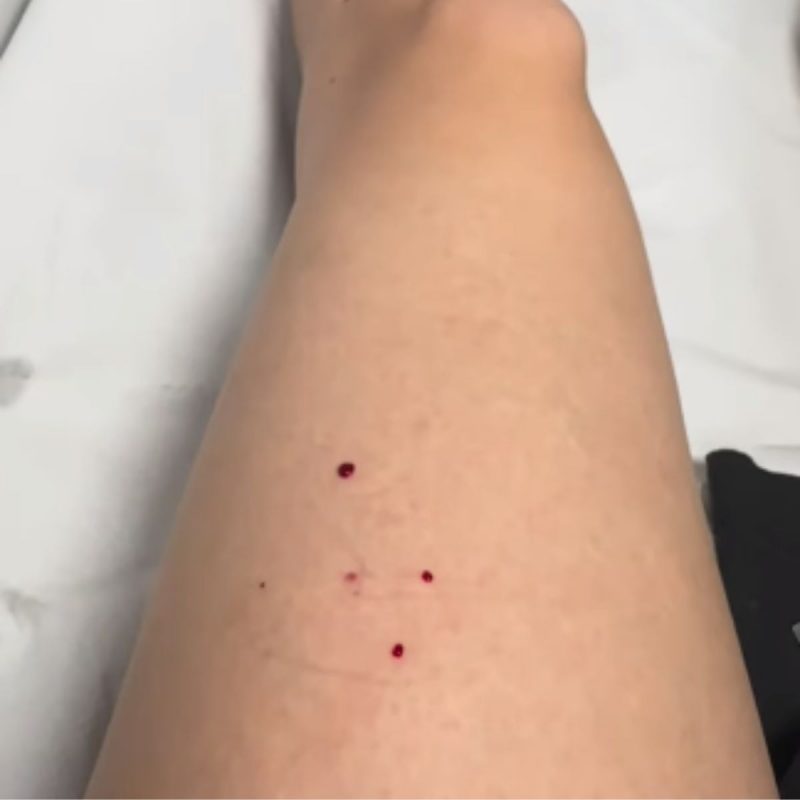 Ela foi ao hospital e precisar&aacute; tomar vacinas durante as pr&oacute;ximas duas semanas – Foto: Divulgado na Internet/Reprodu&ccedil;&atilde;o/ND