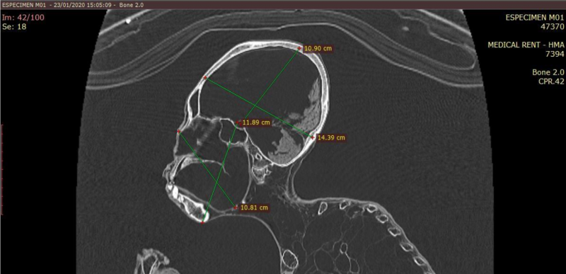 O raio-x de múmia alienígena revelou que seu crânio é 30% maior que se um ser humano comum - Foto: Reprodução/ResearchGate