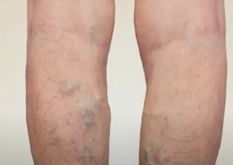 Chá para melhorar varizes e circulação ruim