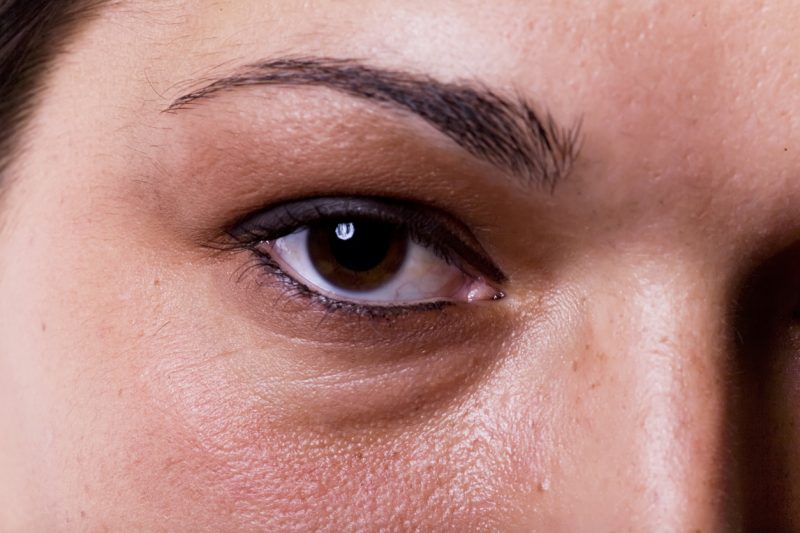 Como acabar com as olheiras: especialista dá dicas