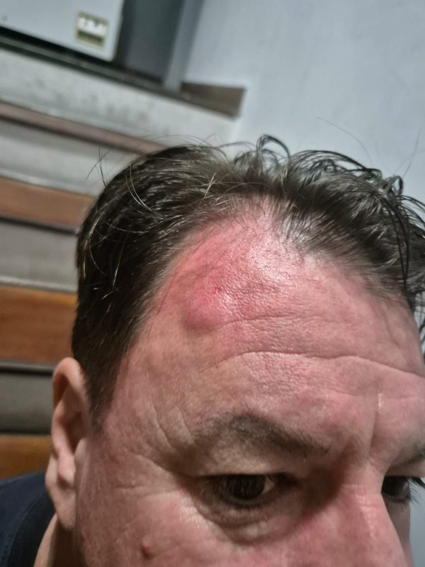 Imagem mostra ferimento na cabeça de vereador de Balneário Camboriú