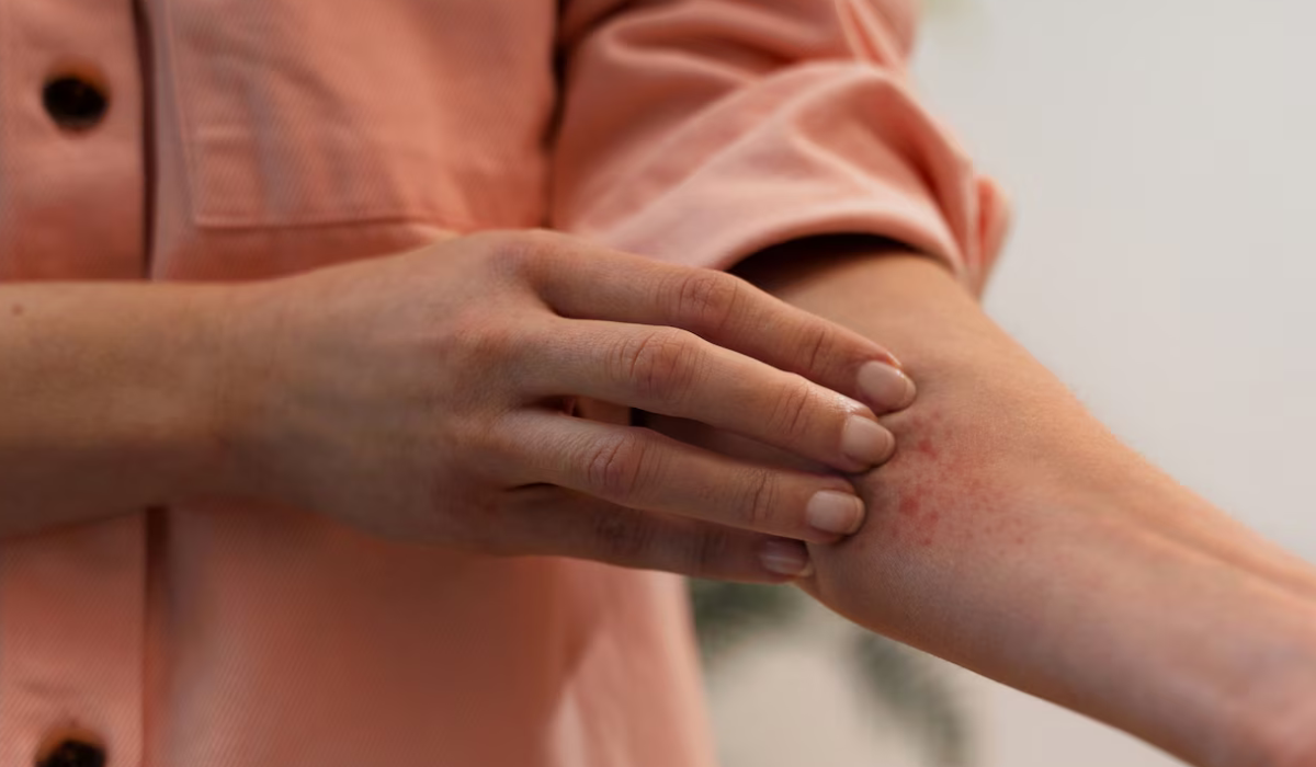 Pessoa com dengue manchada de vermelho se coçando