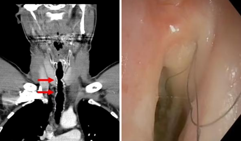 Imagem mostra raio-x indicando ponto na garganta onde foram achados fios de cabelo em paciente