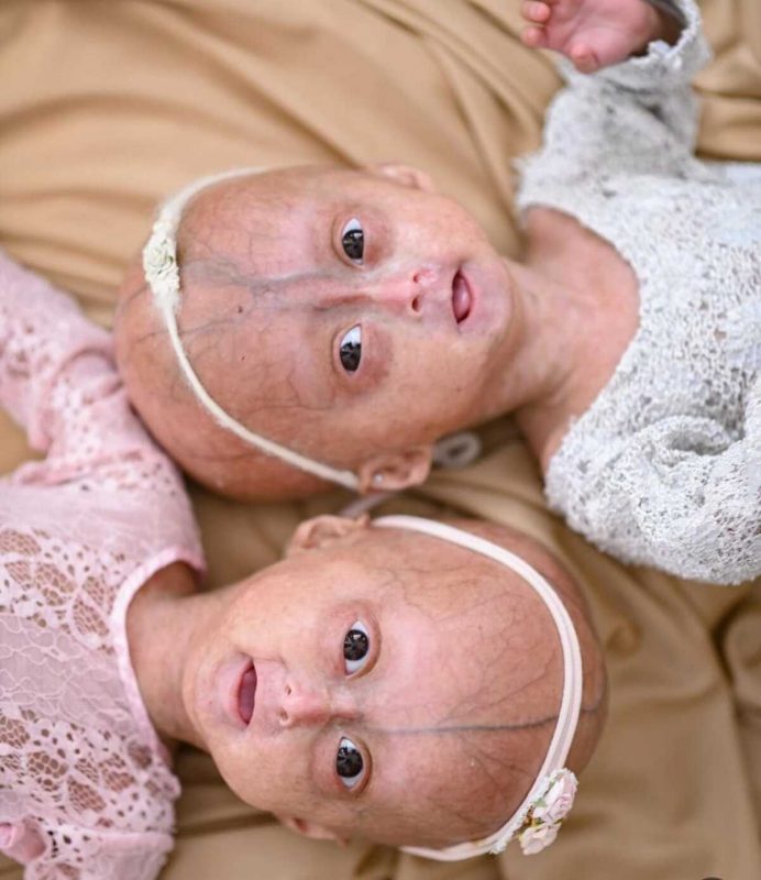 gêmeas que possuem a síndrome da velhice precoce