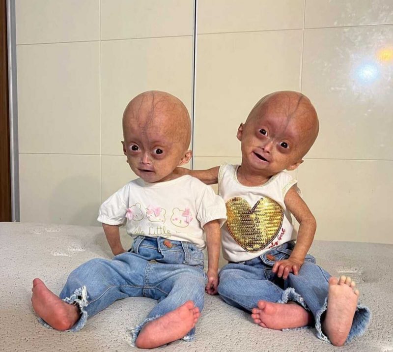 gêmeas que possuem a síndrome da velhice precoce