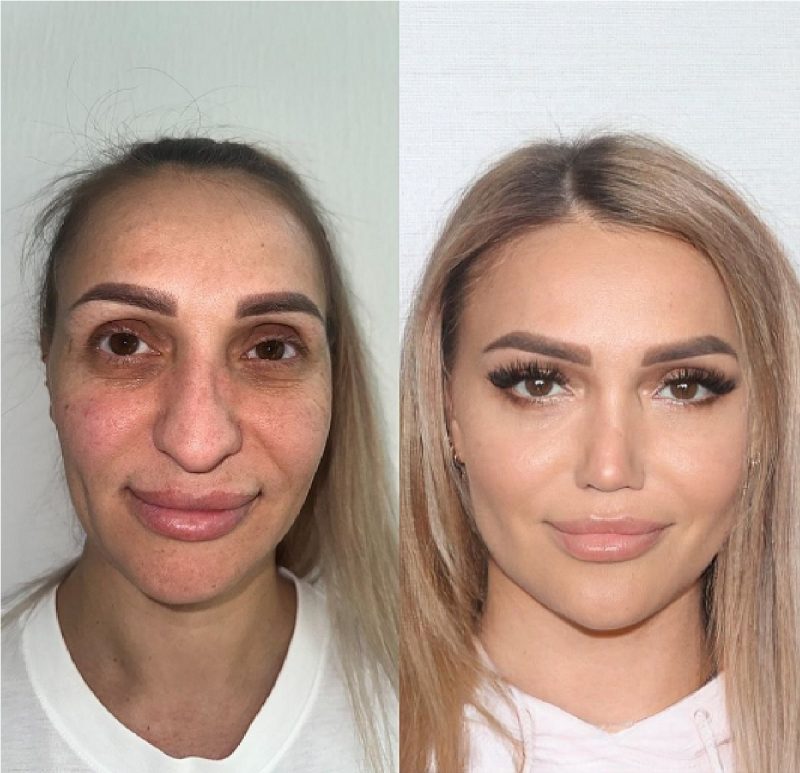 Montagem do antes e depois de mulher após fazer harmonização facial 