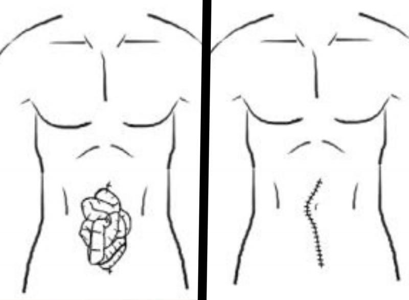 Ilustra&ccedil;&otilde;es dos exames abdominais antes e despois da cirurgia de emerg&ecirc;ncia – Foto: Departamento de Medicina de Emerg&ecirc;ncia da Universidade da Fl&oacute;rida/ND