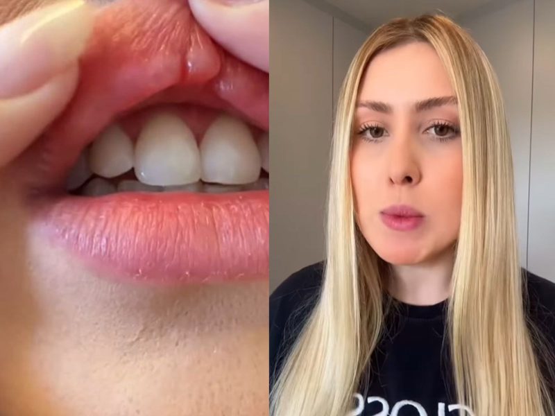 Jovem de SC tem lábios deformados após procedimento cosmético fracassado