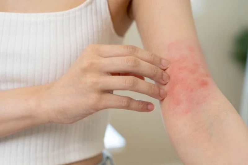 Manchas roxas são sinal de alerta de leucemia — Foto: Reprodução/Shutterstock
