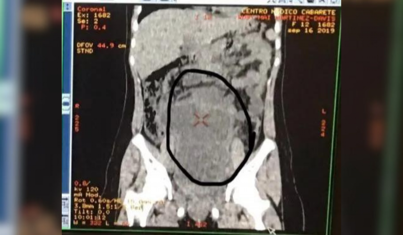 Exame de raio-x mostra abdômen de paciente que tinha tumor com cabelos, dentes e ossos