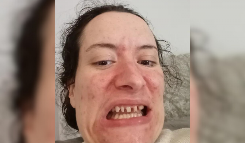 Mulher com condição que faz pessoas rangerem os dentes - mulher branca sorrindo com os dentes desgastados