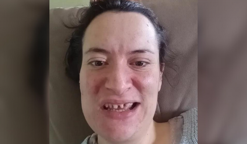 Mulher com condição que faz pessoas rangerem os dentes - Mulher branca sorrindo com dentes desgastados 
