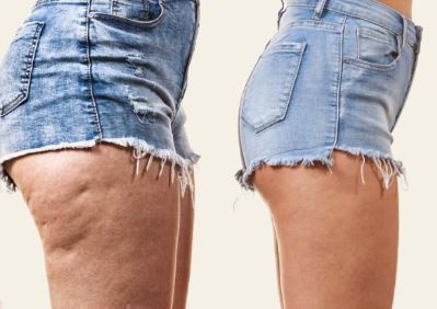 Atenuar a apar&ecirc;ncia leva tempo e &eacute; preciso ter consist&ecirc;ncia – Foto: Reprodu&ccedil;&atilde;o/Internet/ND