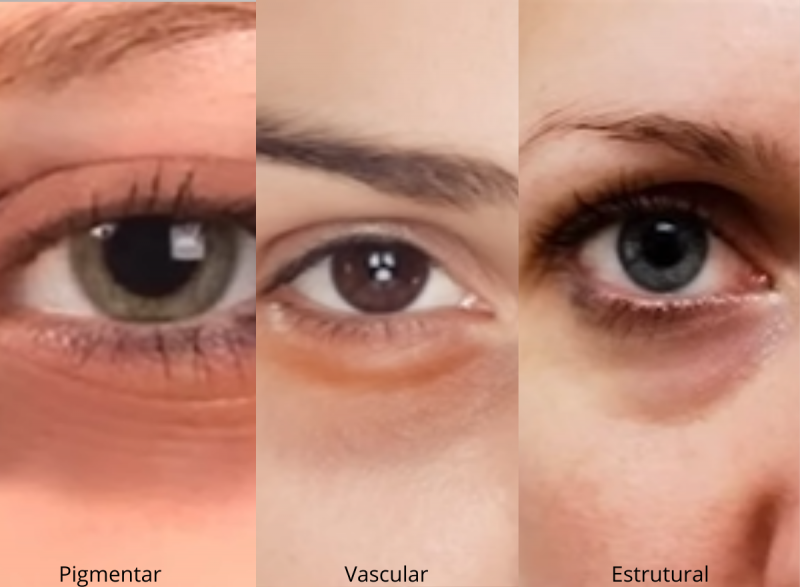 Como acabar com as olheiras: especialista explica quais são os três tipos mais comuns
