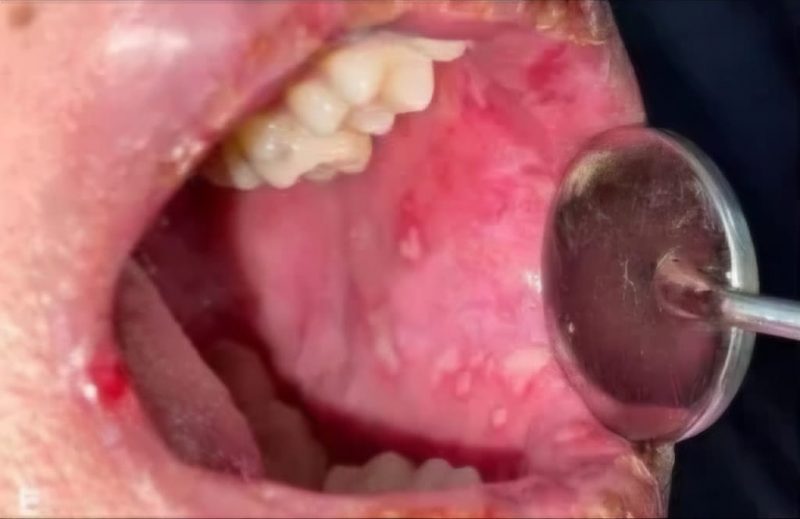 Vape causou o aparecimento de &uacute;lceras crostosas na boca de jovem e levanta alerta – Foto: ncbi.nlm.nih.gov/ND