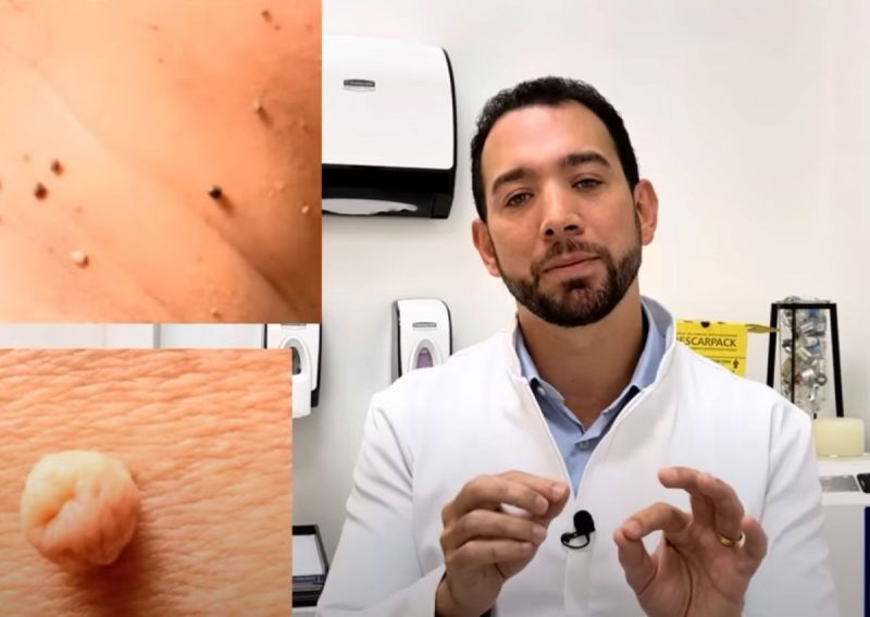 M&eacute;dico ensina como acabar com o inc&ocirc;modo, mas apenas em certos casos – Foto: Reprodu&ccedil;&atilde;o