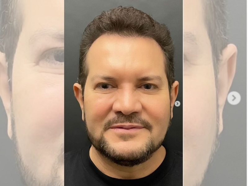 Ximbinha remove gorduras do rosto em cirurgia estética e impressiona: veja o antes e depois