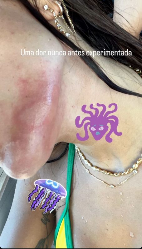 Anitta é atacada por água-viva durante viagem