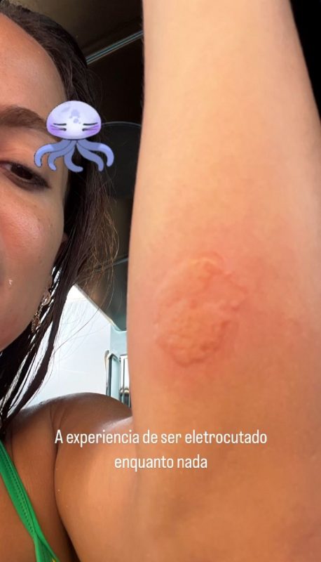 Anitta é atacada por água-viva durante viagem