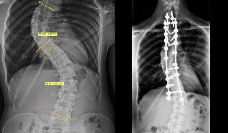 cirurgias ortopédicas são as que apresentam maior número de cirurgias eletivas, foto mostra antes e depois da coluna vertebral