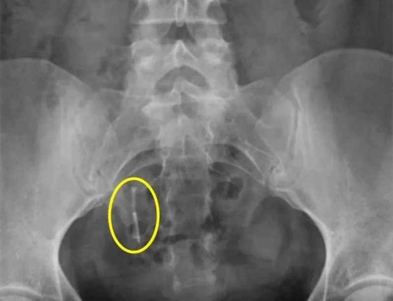 Raio-X de Daniella, que ficou com DIU 'perdido' dentro do corpo